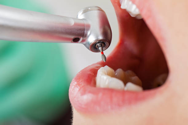 Best Emergency Broken Tooth Repair in Mledgevle, IL